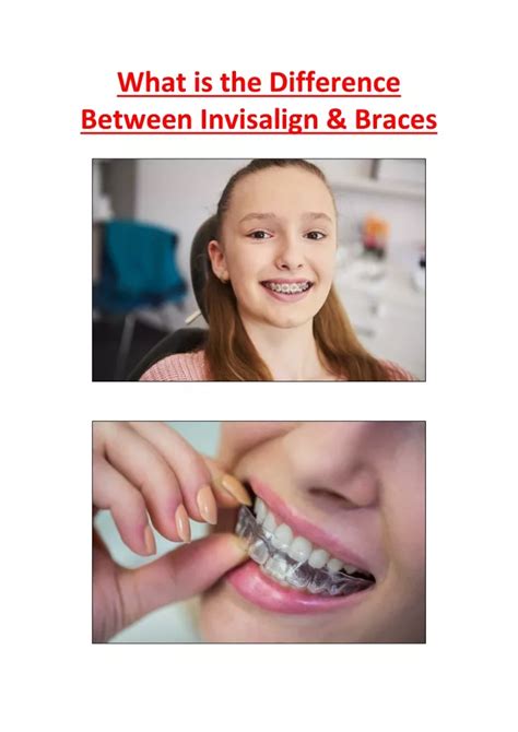 Ppt What Is The Difference Between Invisalign And Braces Powerpoint