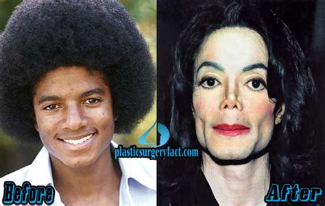 Michael Jackson Plastic Surgery Before And After Photos Plastic