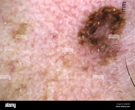 Melanoma In Situ Dermoscopy Stock Photo Alamy