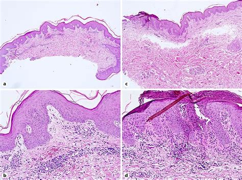 Parakeratosis And Minimal Hyperplasia In An Area Of The Epidermis A B