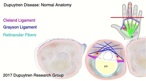 Dupuytren Disease Anatomy Youtube