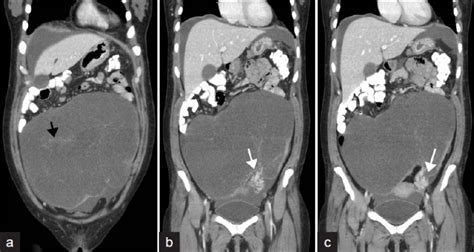 Contrast Enhanced Coronal Ct Images Of The Abdomen And Pelvis