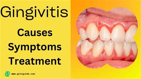 Understanding Gingivitis Causes Symptoms And Treatment