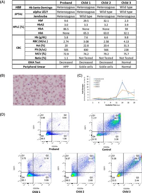 A Laboratory Data And Mutations In Hbb And Spta In The Proband And