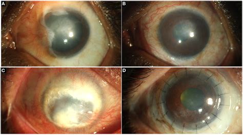 A Partial Limbal Stem Cell Deficiency Lscd Following Chemical