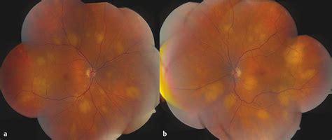 Choroidal And Retinal Metastasis Ento Key