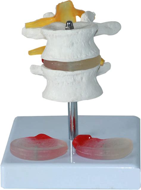 WSXKA Lumbar Vertebrae Model With Diseased Intervertebral India Ubuy