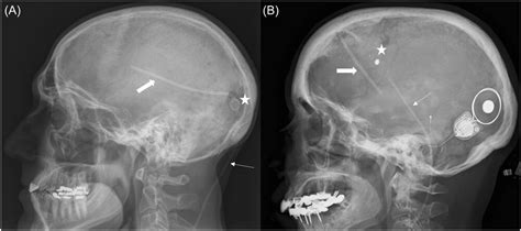 Approach To Cochlear Implantation In Patients With Ventriculoperitoneal