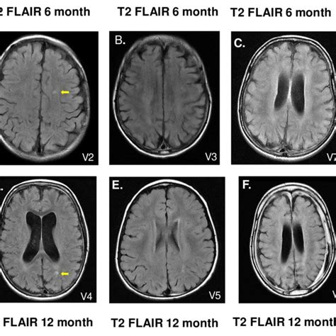 Fig S3 Axial T2 Flair T2 Flair Assessment Of Participants After