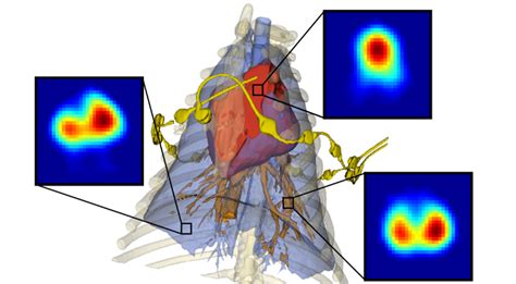 Validation Of Regional Lung Perfusion Based On EIT By Computed