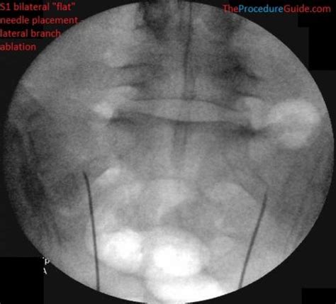 Fluoroscopic Guided Sacroiliac Sij Joint Injection Technique And