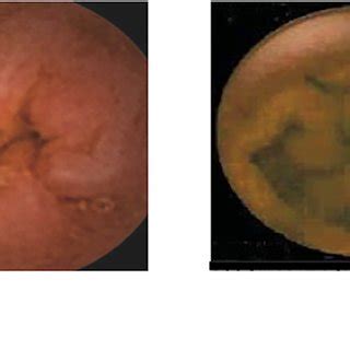 Video Capsule Endoscopy Results Representative Findings From A Normal