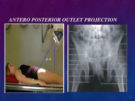 X Ray Pelvis Projections