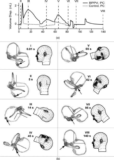 Canalith Repositioning Procedure A Illustrates The Pc Cupula Volume