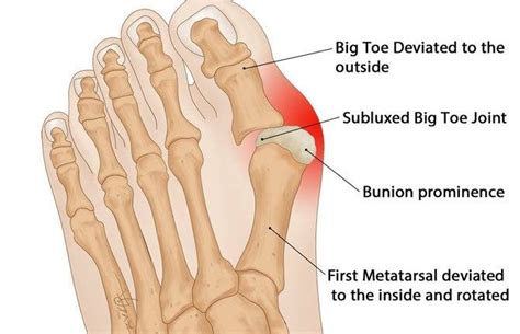 Bunion Treatment Causes Hobart Podiatrist S Guide