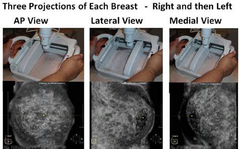 3d Automated Breast Ultrasound