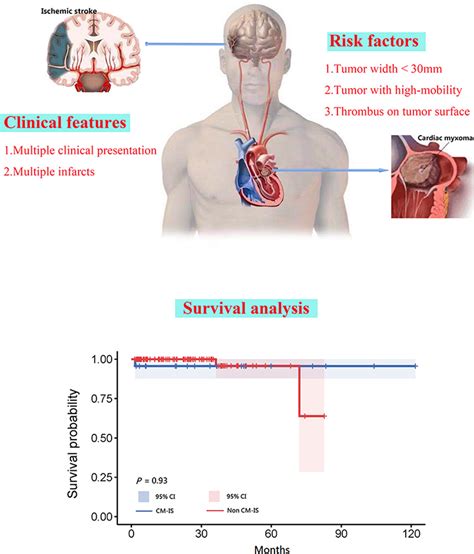 Clinical Features Risk Factors And Survival In Cardiac Myxoma Related