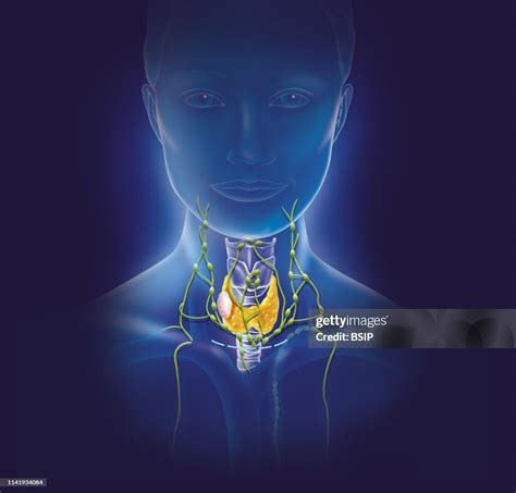 Illustration Of A Thyroid Nodule And The Surrounding Gland Chain