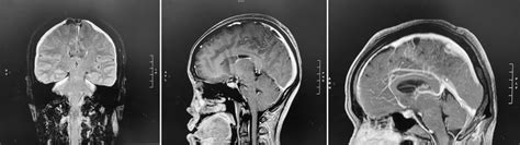 Classical MRI brain findings of spontaneous intracranial hypotension.... | Download Scientific ...