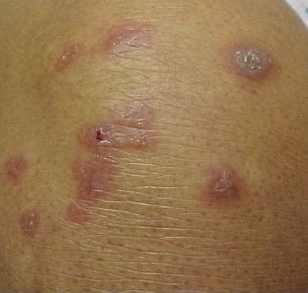 Sarcoidosis (cutaneous sarcoidosis)