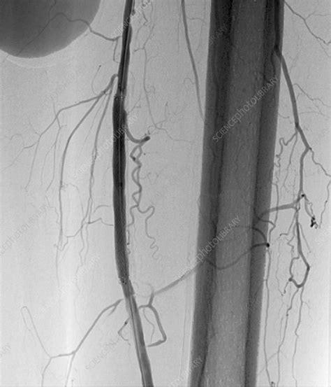 Femoral Artery Stent Procedure