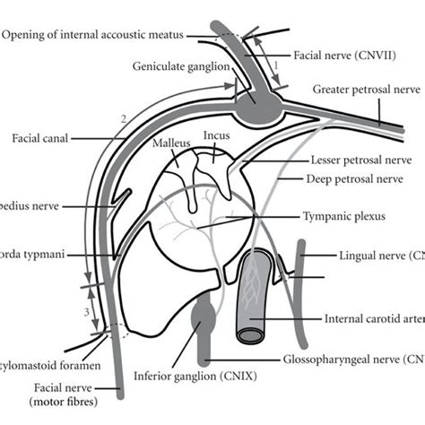 Dissection of the whole chorda tympani nerve from facial nerve, passing ...