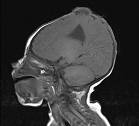 Two Different Management Modalities In A Two Sibling Case Report Of