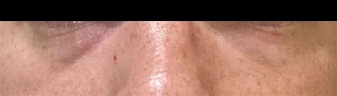 Skin Concerns Dry Peeling Skin Around Eyes Heavy Wrinkle Lines R