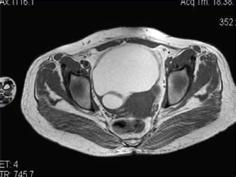 Figure 11 From Role Of Mri In Usual And Unusual Female Pelvic Pathologies With Usual