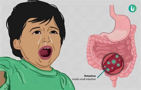 Rotavirus Symptoms Causes Treatment Medicine Prevention Diagnosis