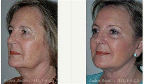 61 Year Old Woman Treated With Facelift Before After With Doctor