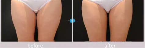 Coolsculpting Before And After Photos Skinney Medspa