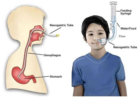 Ng Tube Medizzy