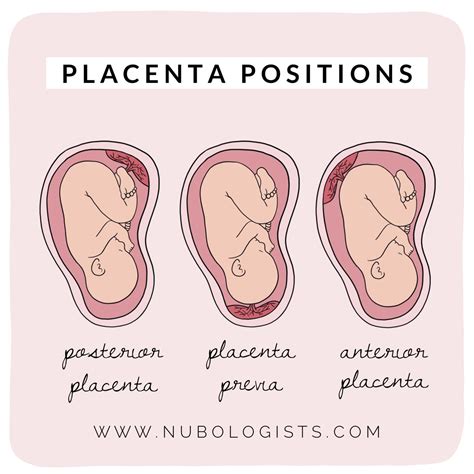 Comprehensive Guide To Placenta Location And Placenta Previa Types What You Need To Know Artofit