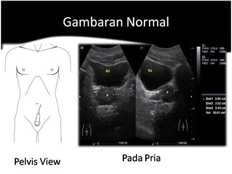 Cafe Radiologi Penatalaksanaan Usg Abdomen