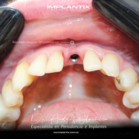 Cirug A Pl Stica Periodontal