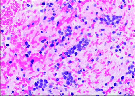 Hematoxylin And Eosin H E Stain Of Fine Needle Aspiration Cytology