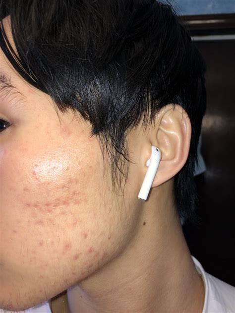 Routine Help Noticeably Visible Pihpie And Acne Scars Any Way To