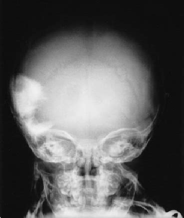 Plain X Ray Film Of The Skull Shows A Tumor With Spicules And Sclerotic