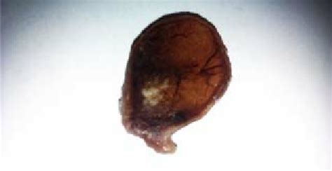 Tumor Composed Of Lobules Of Mature Adipocytes Immediately Under The