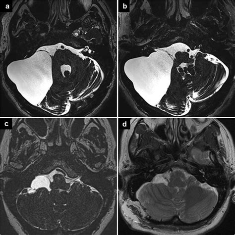 Arachnoid Cyst Mri