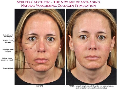 Dermal Facial Fillers In Appleton And Oshkosh Wi