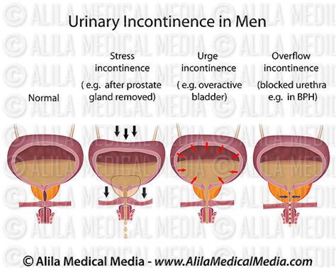 Alila Medical Media | Urinary incontinence in men | Medical illustration