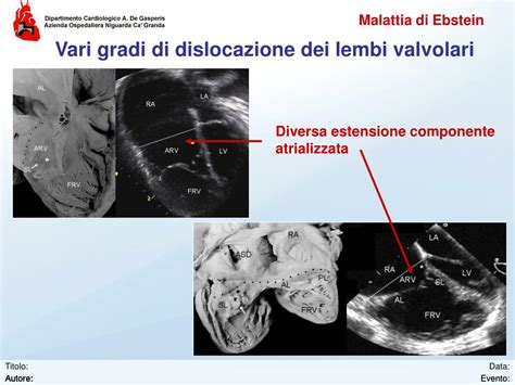 Ppt Malattia Di Ebstein Powerpoint Presentation Free Download Id 4847172