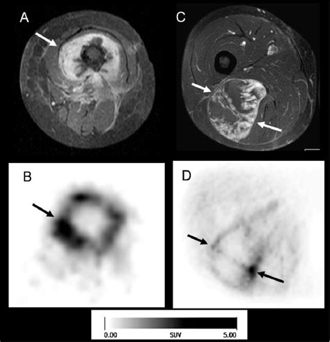 Two Patients With Sarcomas Of The Thigh Arrows On The Left Side A