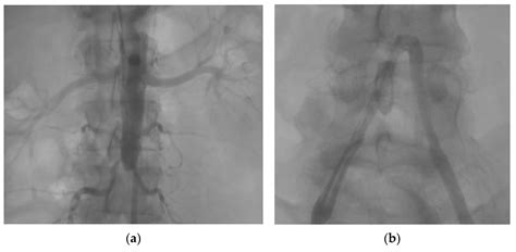 Diagnostics Free Full Text Chronic Complete Distal Aortic Occlusion