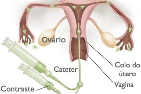 Histerossalpingografia O Que Como Feito E Preparo Para O Exame