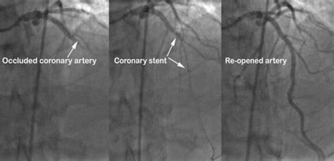 Angioplasty And Stent Your Practical Exercise Guide 2023