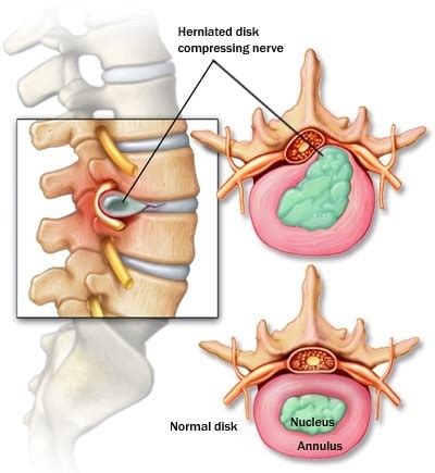 Cervical Lumbar Herniated Disc Nashville Neurosurgery Associates