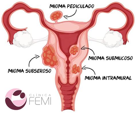 Mioma Uterino Sintomas Tratamentos E Causas Cl Nica Femi